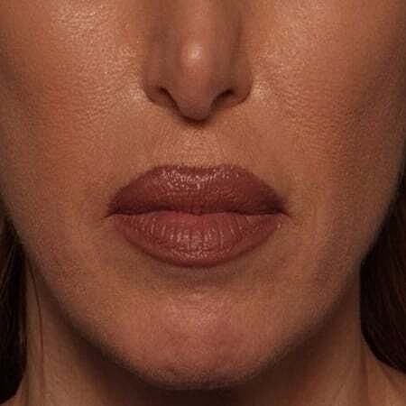 Facial Fillers Before & After