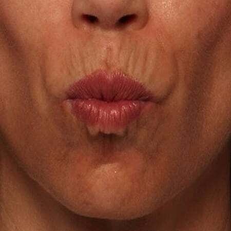 Facial Fillers Before & After