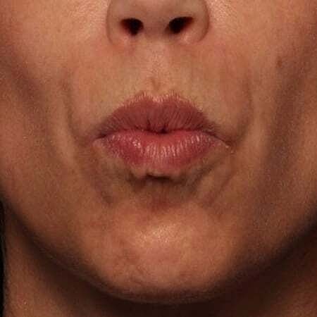 Facial Fillers Before & After