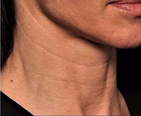 Facial Fillers Before & After