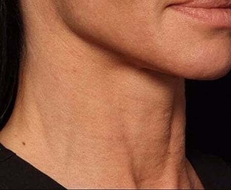 Facial Fillers Before & After