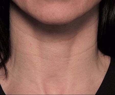 Facial Fillers Before & After