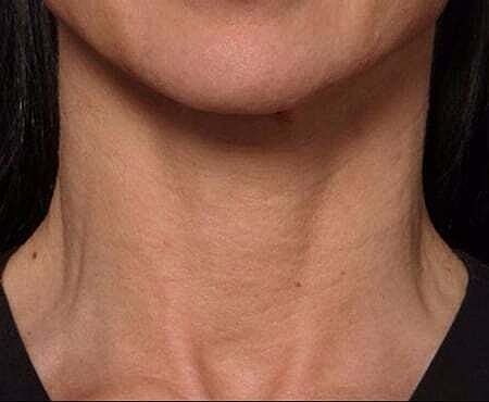 Facial Fillers Before & After