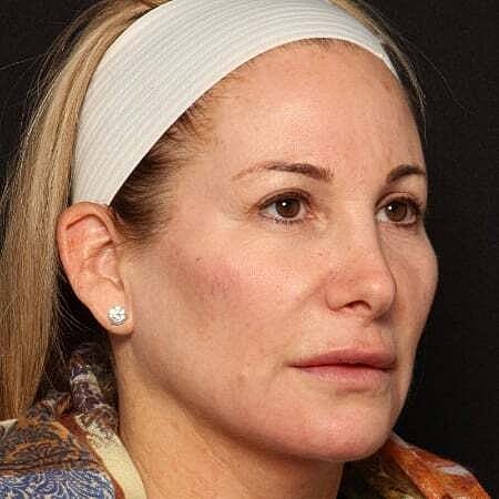 Facial Fillers Before & After