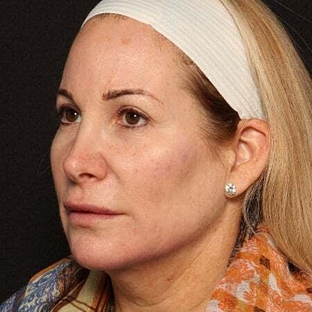 Facial Fillers Before & After