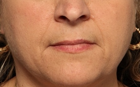 Facial Fillers Before & After