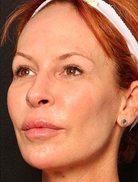 Facial Fillers Before & After