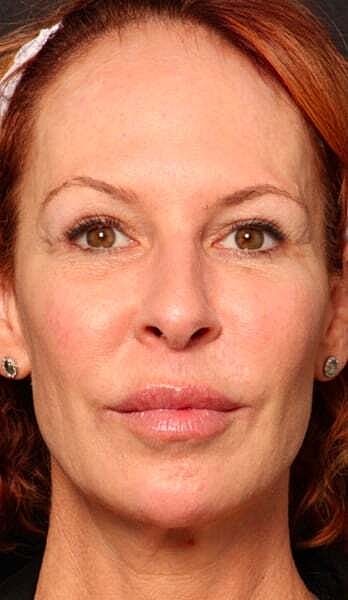 Facial Fillers Before & After