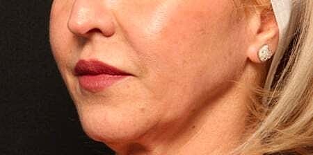 Facial Fillers Before & After