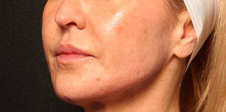 Facial Fillers Before & After
