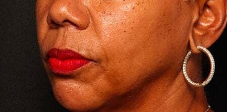 Facial Fillers Before & After