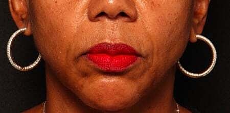 Facial Fillers Before & After