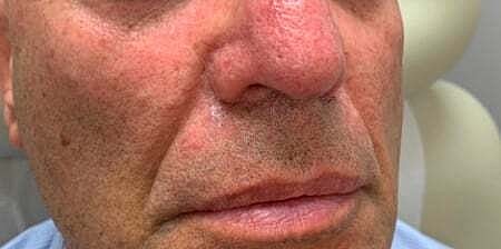 Facial Fillers Before & After