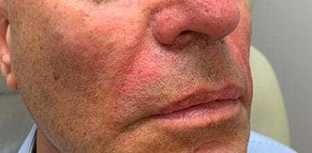 Facial Fillers Before & After