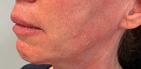 Facial Fillers Before & After