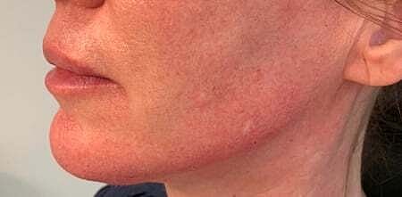 Facial Fillers Before & After