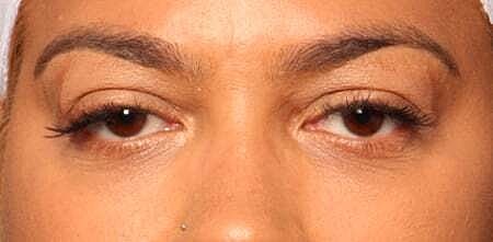 Facial Fillers Before & After