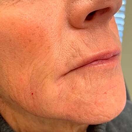 Facial Fillers Before & After