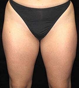 Liposuction Before & After