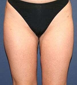 Liposuction Before & After