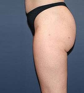 Liposuction Before & After