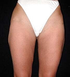Liposuction Before & After