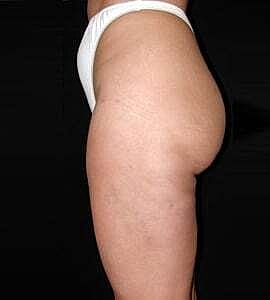 Liposuction Before & After