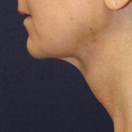 Liposuction Before & After