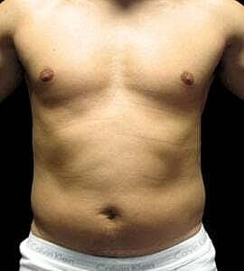 Liposuction Before & After