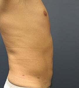 Liposuction Before & After
