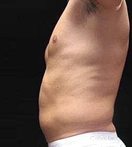 Liposuction Before & After