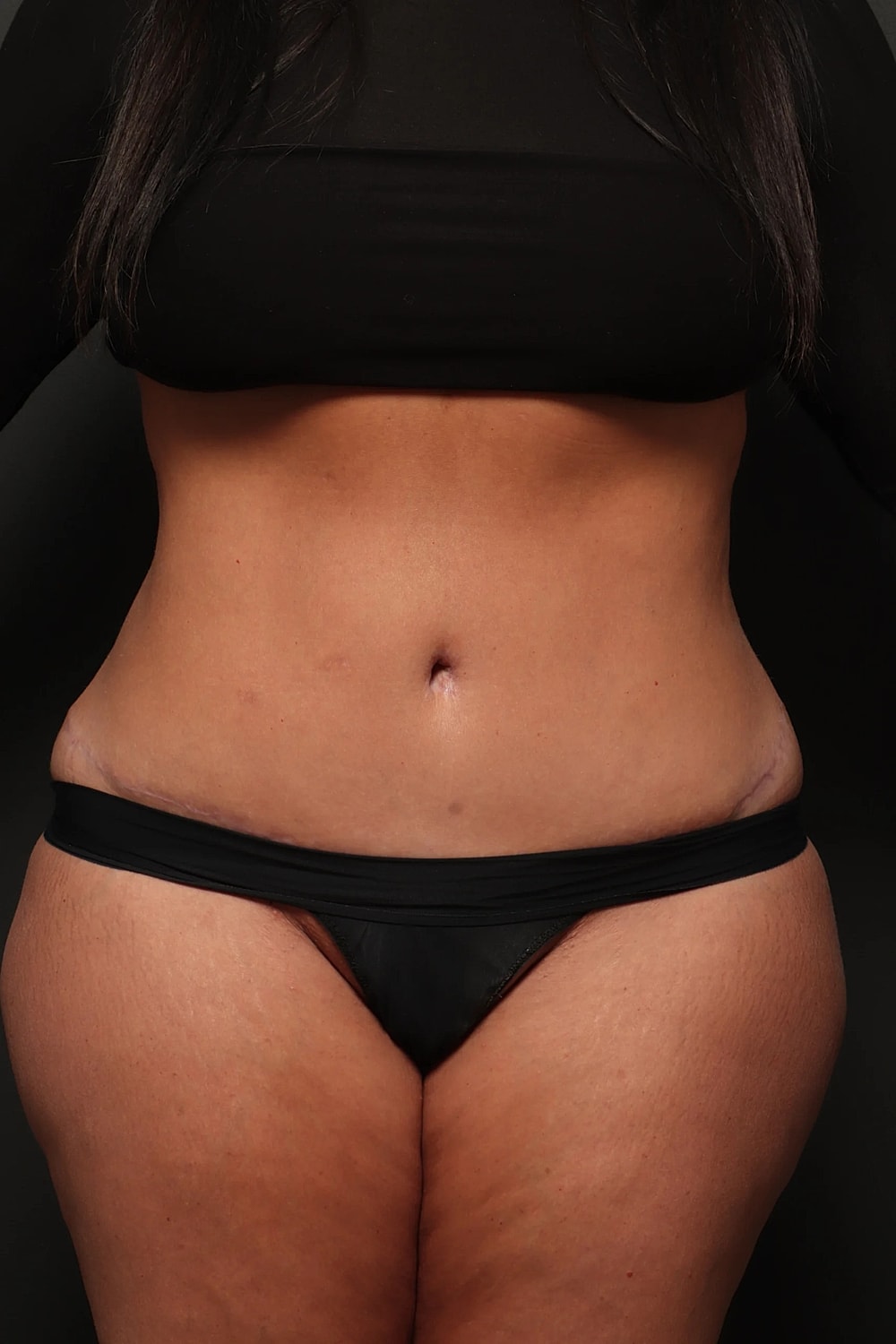 Liposuction Before & After