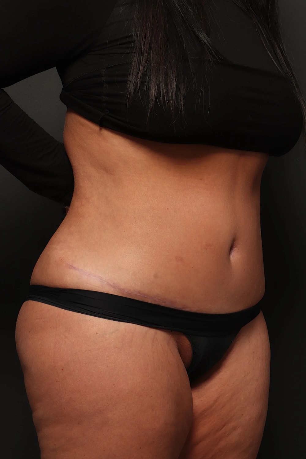 Liposuction Before & After