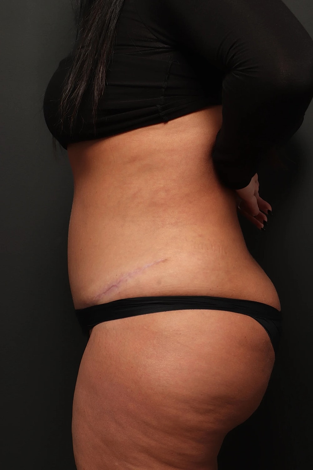 Liposuction Before & After