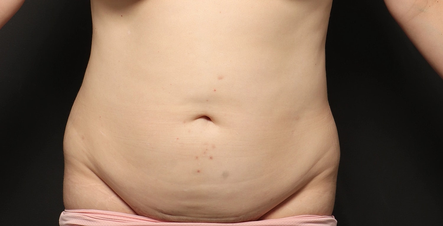 Liposuction Before & After