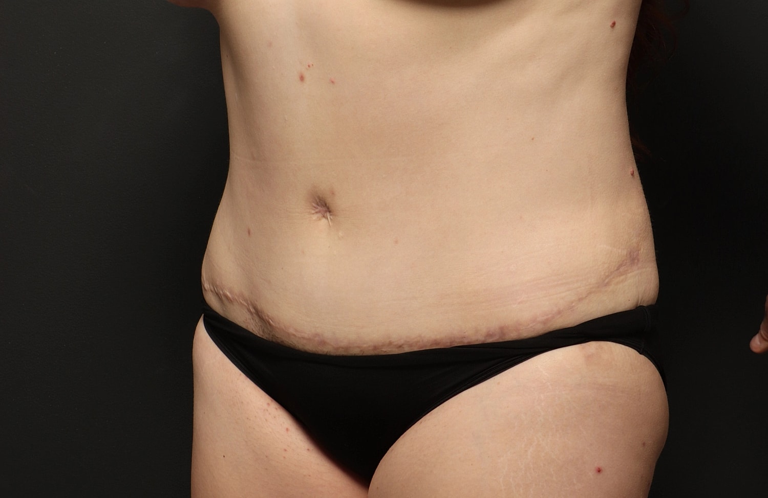 Liposuction Before & After