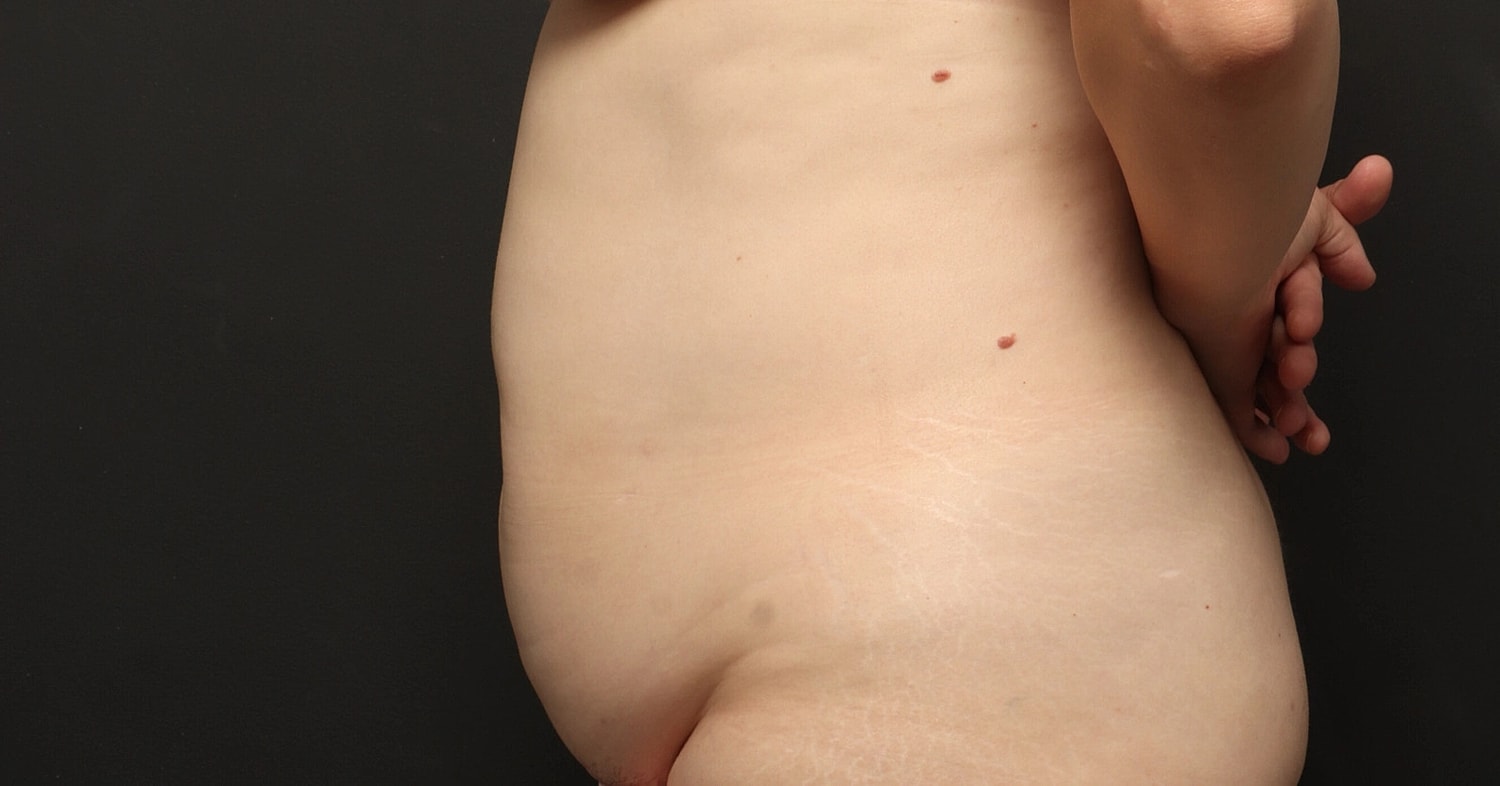 Liposuction Before & After