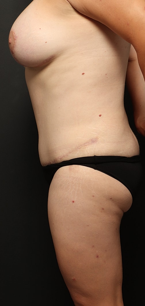 Liposuction Before & After