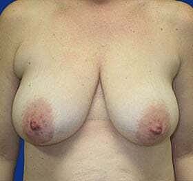 Breast Lift Before & After