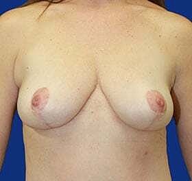 Breast Lift Before & After