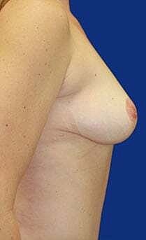 Breast Lift Before & After