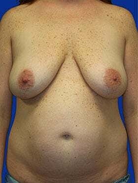 Breast Lift Before & After