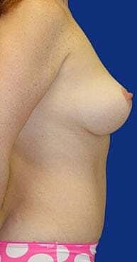 Breast Lift Before & After