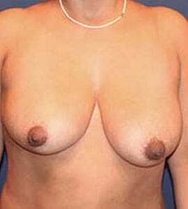 Breast Lift Before & After