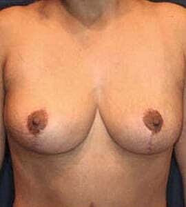 Breast Lift Before & After