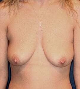 Breast Lift Before & After
