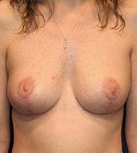 Breast Lift Before & After