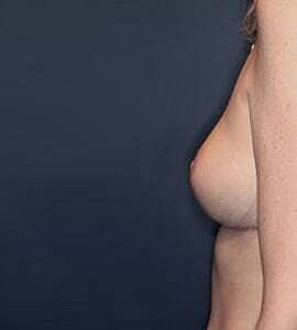 Breast Lift Before & After