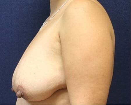 Breast Lift Before & After