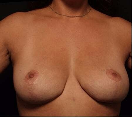 Breast Lift Before & After
